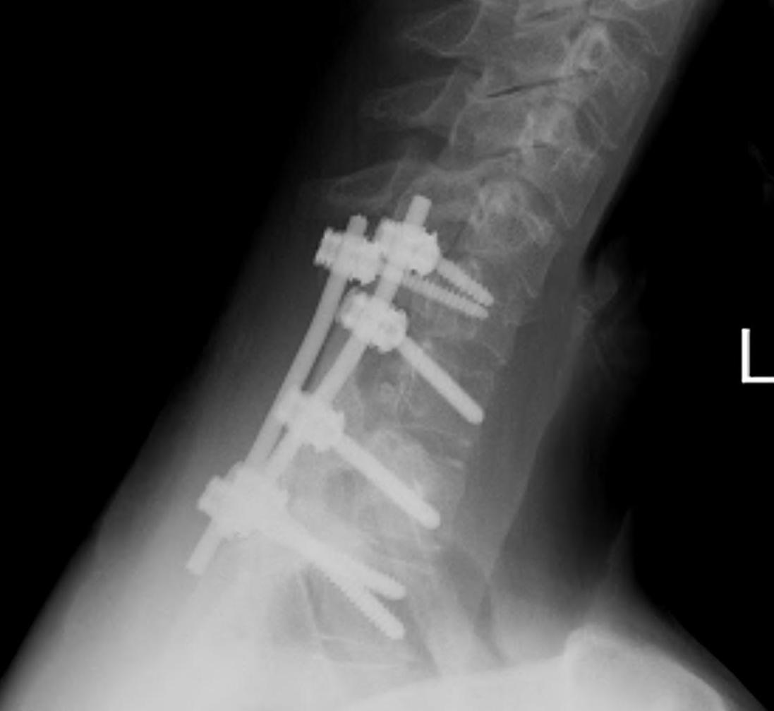 Osteoblastoma Exision and Fusion0001